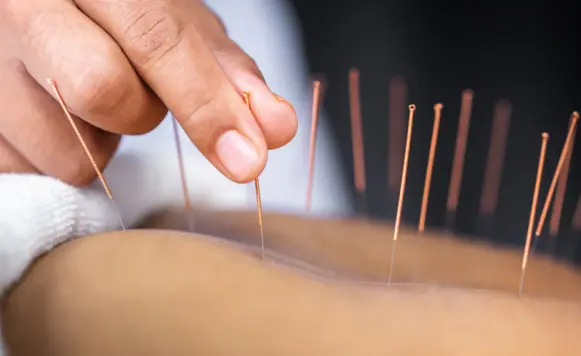 Acupuncture